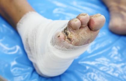 Diabetes Foot & Wound Care